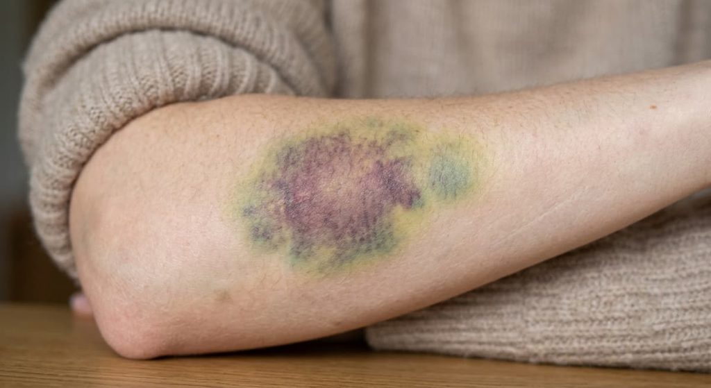 Bruise changing from purple to green and yellow during healing