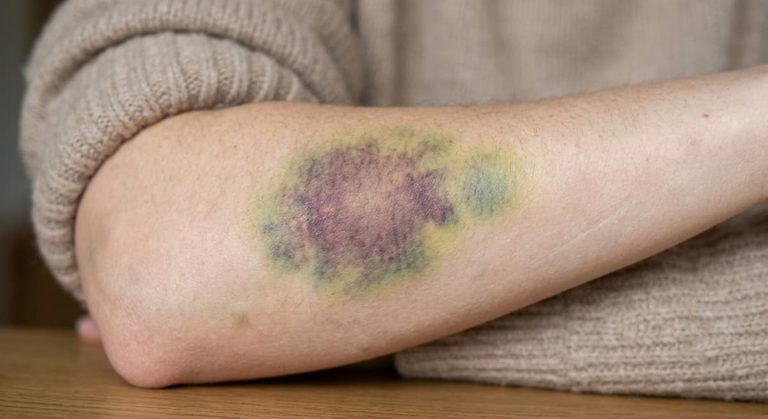 Why Do Bruises Change from Purple to Yellow? The Chemistry of Hemoglobin Breakdown [Bit#175]